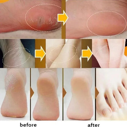 Herbal Anti Crack Foot Cream Peeling Spray Heel Cracking Repair Products Exfoliation Dead Skin Removal Softening Smooth Care