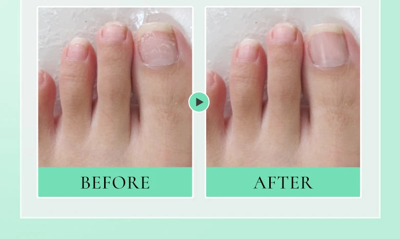 Nail Nourishment Cuticle Oil Pen Gel Suitable Hand/Feet Vitamin E Finger Nails Treatment Serum Nail Care