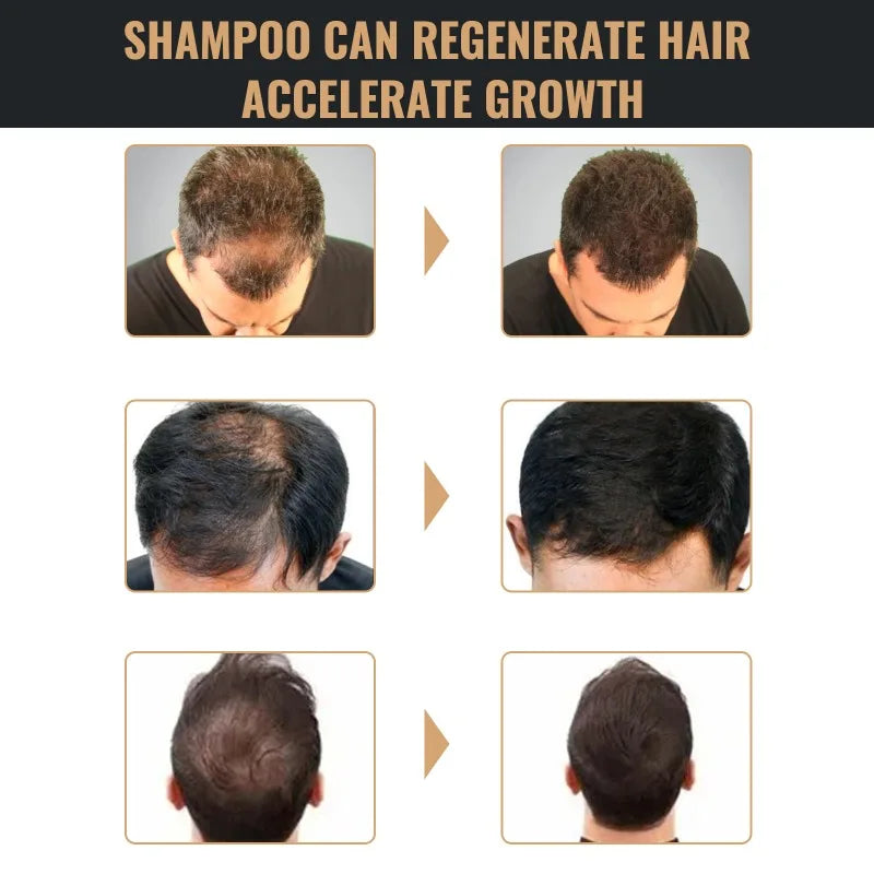 Hair Loss Treatment Shampoo Promote Growth Strengthen Hair Roots Scalp Repair Anti Thinning Moisturizing Thickening Hair Care