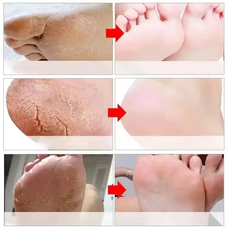 Herbal Anti Crack Foot Cream Peeling Spray Heel Cracking Repair Products Exfoliation Dead Skin Removal Softening Smooth Care