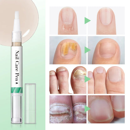 1/2pc Nail Care Mild Ingredients Prevent Damaged Nail Bed Treat Onychomycosis Nail Repair Pen For Nail Beauty Health Care Tools