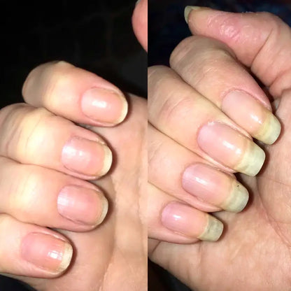 LOVCARRIE Nail Growth 5 to 7 Day Strong Nail Strengthener Calcium Protein Formula Strong Nails Hardener Protect Soft Thin Nails