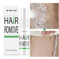 Hair Removal