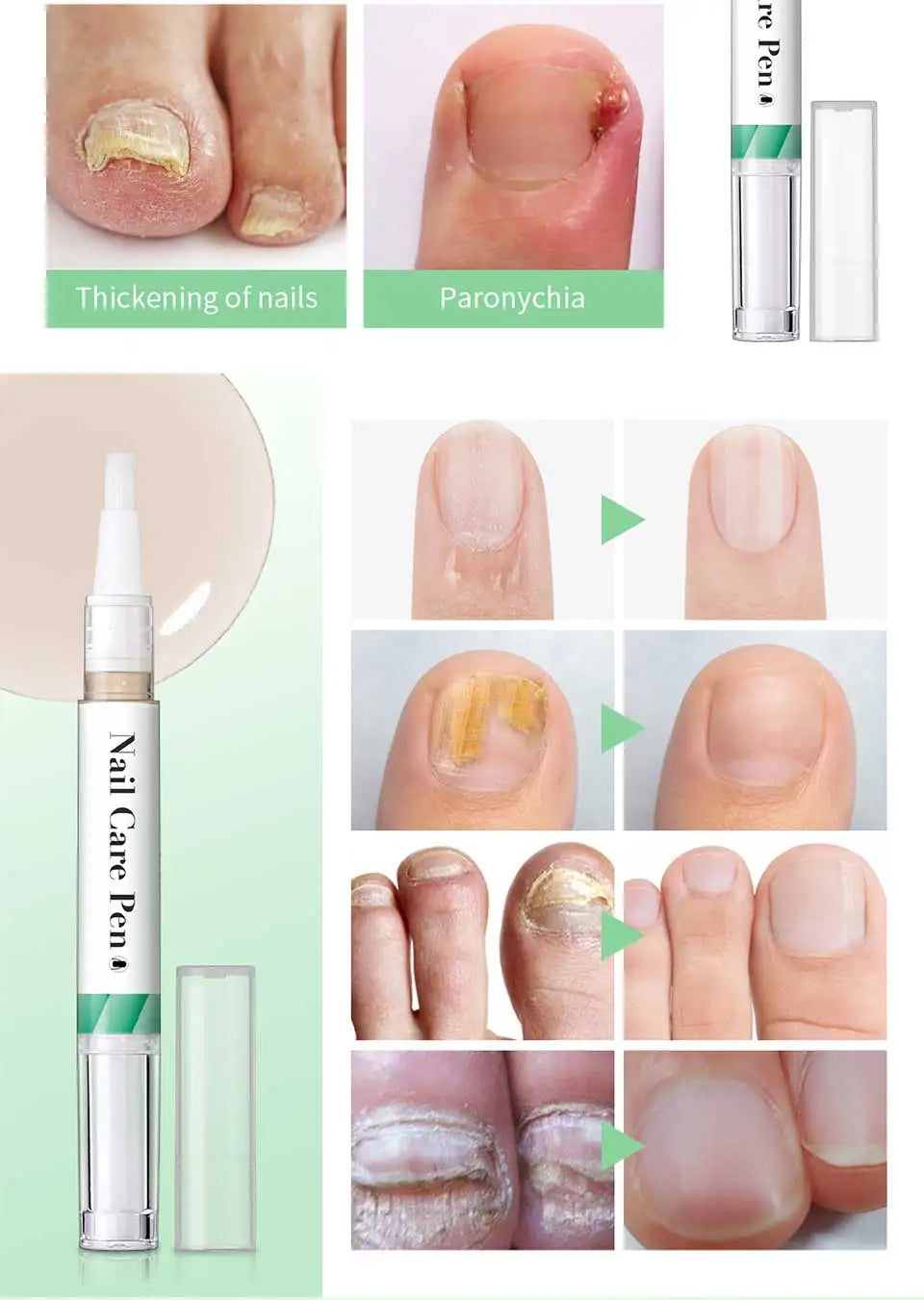 1/2pc Nail Care Mild Ingredients Prevent Damaged Nail Bed Treat Onychomycosis Nail Repair Pen For Nail Beauty Health Care Tools