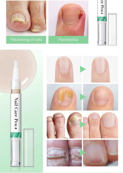 1/2pc Nail Care Mild Ingredients Prevent Damaged Nail Bed Treat Onychomycosis Nail Repair Pen For Nail Beauty Health Care Tools