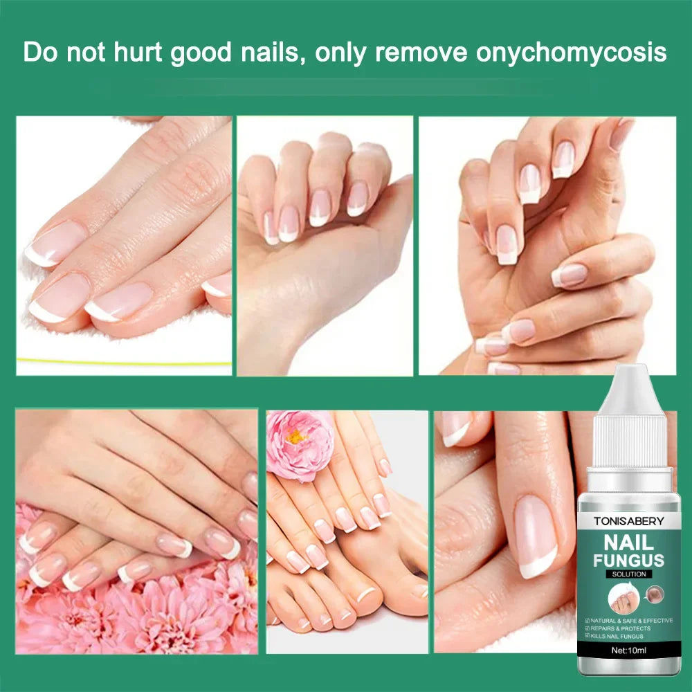 Nail Fungal Treatment Feet Care Essence Anti Infection Onychomycosis Removal Toe Nails Foot Fungus Paronychia Nail Care Uñas